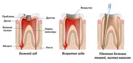 Болить зуб після пломбування скільки триває біль і що робити (пломбування) Болить зуб після пломбування скільки триває біль і що робити