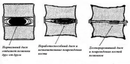 Біль в попереку при ходьбі, розгинанні і згинанні, нахилі, вставанні, лежачи на животі або спині, (біль поперек ходьба розгинання згинання нахил лежачи вдих) Біль в попереку при ходьбі, розгинанні і згинанні, нахилі, вставанні, лежачи на животі або спині,