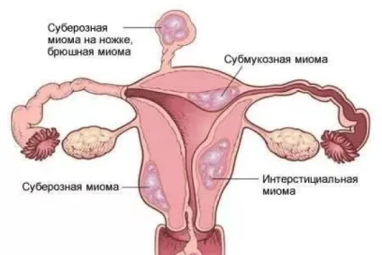 Борова матка і червона щітка при міомі (борова) Борова матка і червона щітка при міомі