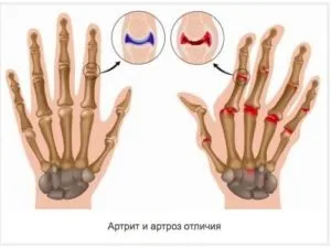Чим відрізняється артрит від артрозу - симптоми, причини (симптоми) Чим відрізняється артрит від артрозу - симптоми, причини