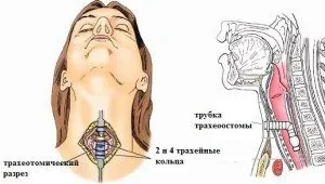 Що робити при алергічному набряку горла - перша допомога (що робити при алергічному набряку горла перша допомога) Що робити при алергічному набряку горла - перша допомога