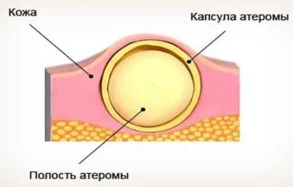 Що робити, якщо з'явився кулька в мочці вусі будьте здорові (кульку) Що робити, якщо з'явився кулька в мочці вусі будьте здорові