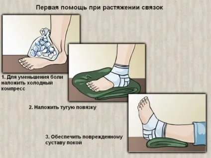 Що робити при розтягуванні зв'язок ноги (зв'язок) Що робити при розтягуванні зв'язок ноги