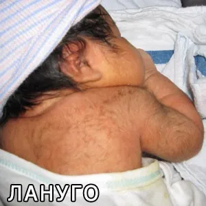 Що таке лануго у новонароджених дітей (що таке лануго) Що таке лануго у новонароджених дітей