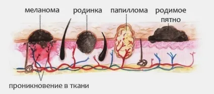 Що таке бородавка будова, види, відмінність від інших наростів (бородавка) Що таке бородавка будова, види, відмінність від інших наростів