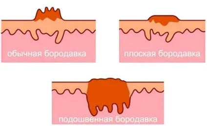 Що таке бородавка будова, види, відмінність від інших наростів (види) Що таке бородавка будова, види, відмінність від інших наростів