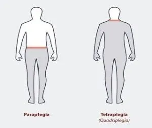 Що таке тетраплегия (Квадріплегія) як лікувати синдром, причини і прогноз (прогноз) Що таке тетраплегия (Квадріплегія) як лікувати синдром, причини і прогноз