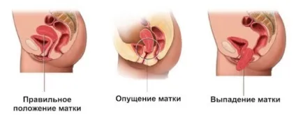 Що таке опущення матки