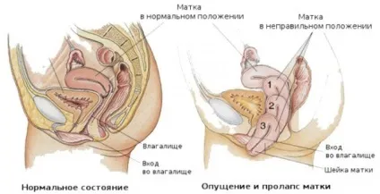 Що таке опущення матки