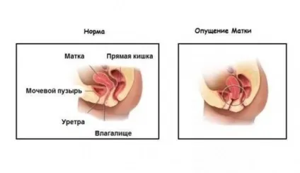 Що таке опущення матки