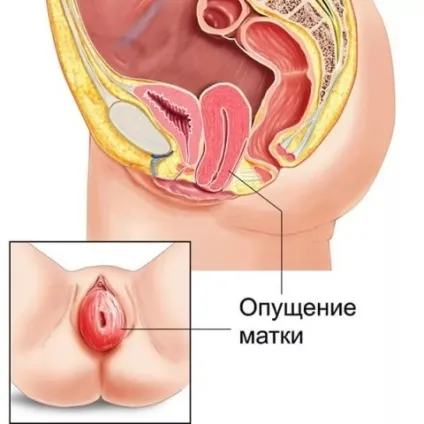 Що таке опущення матки