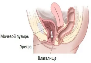 Цистоцеле - що це таке лікування опущення сечового міхура у жінок (опущення сечового міхура симптоми) Цистоцеле - що це таке лікування опущення сечового міхура у жінок