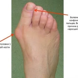 деформація стопи