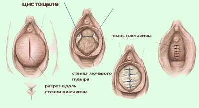 Цистоцеле - що це таке лікування опущення сечового міхура у жінок (опущення сечового міхура симптоми) Цистоцеле - що це таке лікування опущення сечового міхура у жінок
