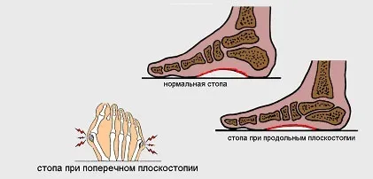 деформація стопи