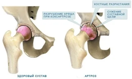 Деформуючий артроз тазостегнового суглоба 1, 2 ступеня причини, симптоми, лікування (суглоба) Деформуючий артроз тазостегнового суглоба 1, 2 ступеня причини, симптоми, лікування