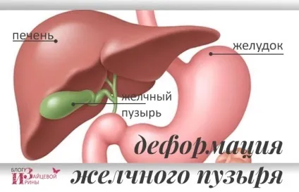 Деформація жовчного міхура, блог Ірини Зайцевої (перегини жовчного міхура) Деформація жовчного міхура, блог Ірини Зайцевої