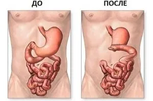 Дієта після операції виразки шлунка