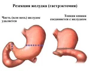 Дієта після операції виразки шлунка