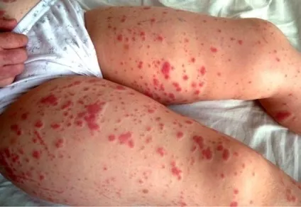 Діатез у дітей симптоми і лікування профілактика фото і дорослих (лікування) Діатез у дітей симптоми і лікування профілактика фото і дорослих
