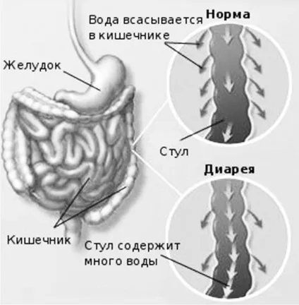 Діарея після їжі основні причини проносу після прийому їжі (діарея) Діарея після їжі основні причини проносу після прийому їжі