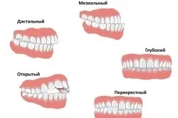 До якого віку можна ставити брекети