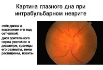 Simptome nevrite optice retrobulbare, tratament