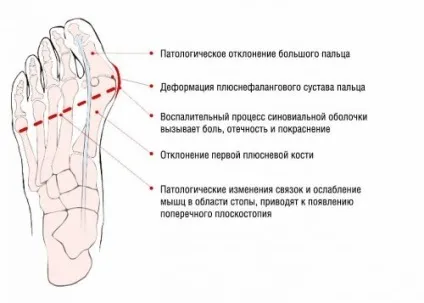 Фіксатор для кісточки на нозі огляд видів і способів застосування (кут відхилення пальця) Фіксатор для кісточки на нозі огляд видів і способів застосування