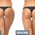 Галіфе на стегнах як прибрати масаж і вправи, дієта і відео (масаж) Галіфе на стегнах як прибрати масаж і вправи, дієта і відео