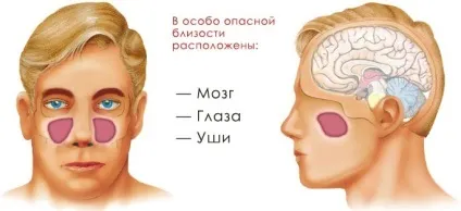 Гайморит ускладнення і наслідки (запалення гайморових пазух) Гайморит ускладнення і наслідки