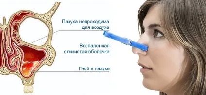 Гайморит ускладнення і наслідки (гайморит) Гайморит ускладнення і наслідки