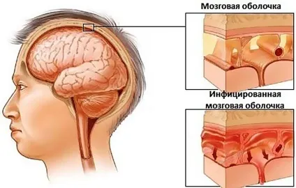 Гайморит ускладнення і наслідки (наслідки) Гайморит ускладнення і наслідки