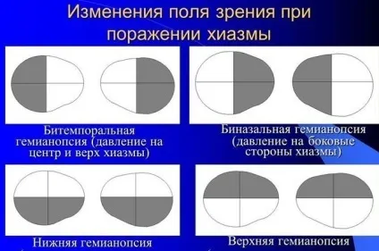 Геміанопсія (гомонимная, гетеронімная, битемпоральная) симптоми, лікування (гомонимная гемианопсия) Геміанопсія (гомонимная, гетеронімная, битемпоральная) симптоми, лікування
