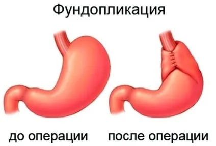 Гастроезофагеальний рефлюкс як розпізнати і провести лікування (лікування) Гастроезофагеальний рефлюкс як розпізнати і провести лікування