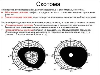 Геміанопсія (гомонимная, гетеронімная, битемпоральная) симптоми, лікування (битемпоральная) Геміанопсія (гомонимная, гетеронімная, битемпоральная) симптоми, лікування
