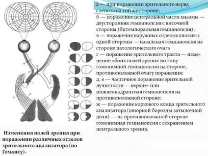 Геміанопсія (гомонимная, гетеронімная, битемпоральная) симптоми, лікування (симптоми) Геміанопсія (гомонимная, гетеронімная, битемпоральная) симптоми, лікування