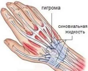 Гігрома що це таке, її симптоми і методи лікування (гігрома симптоми лікування травма пухлина кисть стопа біль плечовий суглоб лазер) Гігрома що це таке, її симптоми і методи лікування
