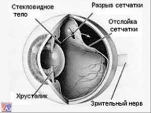 Очі в небезпеці, або що таке розшарування сітківки (таке) Очі в небезпеці, або що таке розшарування сітківки