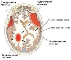 Гігрома що це таке, її симптоми і методи лікування (таке) Гігрома що це таке, її симптоми і методи лікування