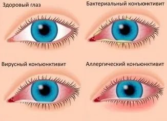 Гнійний кон'юнктивіт у дітей лікування, ніж лікувати у новонароджених, слизисто (кон'юнктивіт) Гнійний кон'юнктивіт у дітей лікування, ніж лікувати у новонароджених, слизисто