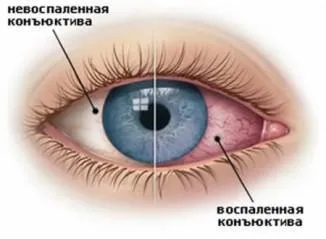Гнійний кон'юнктивіт у дітей лікування, ніж лікувати у новонароджених, слизисто (лікування) Гнійний кон'юнктивіт у дітей лікування, ніж лікувати у новонароджених, слизисто