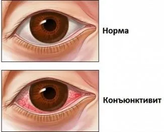 Гнійний кон'юнктивіт у дітей лікування, ніж лікувати у новонароджених, слизисто (лікувати) Гнійний кон'юнктивіт у дітей лікування, ніж лікувати у новонароджених, слизисто