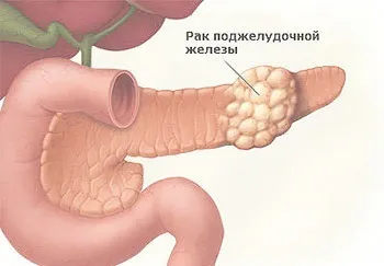 Головка підшлункової залози - розміри, норма, лікування об'ємних утворень (bl, зно), фото (головка) Головка підшлункової залози - розміри, норма, лікування об'ємних утворень (bl, зно), фото