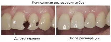 Гнилі зуби причини, лікування і профілактика (лікування) Гнилі зуби причини, лікування і профілактика