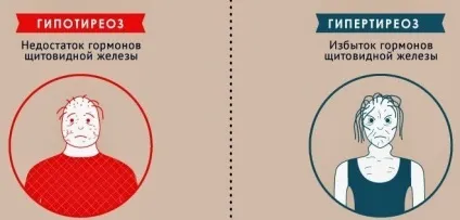 Гіпотиреоз (гіпофункція) щитовидної залози лікування і ксімптоми (гіпотиреоз) Гіпотиреоз (гіпофункція) щитовидної залози лікування і ксімптоми