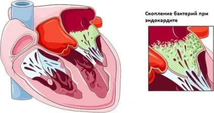 Гнилі зуби причини, лікування і профілактика (гнилі) Гнилі зуби причини, лікування і профілактика