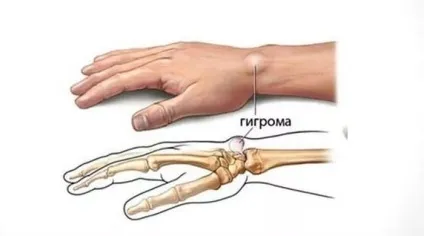 Гігрома що це таке, її симптоми і методи лікування (симптоми) Гігрома що це таке, її симптоми і методи лікування