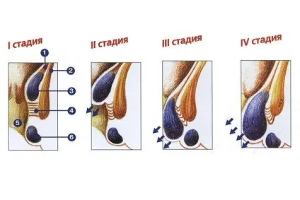 Геморой хронічний причини і симптоми, методи лікування