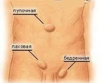 Грижа кишечника - причини, симптоми, діагностика та лікування (кишечника) Грижа кишечника - причини, симптоми, діагностика та лікування