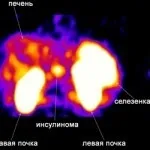 Инсулинома підшлункової залози симптоми, причини (симптоми) Инсулинома підшлункової залози симптоми, причини
